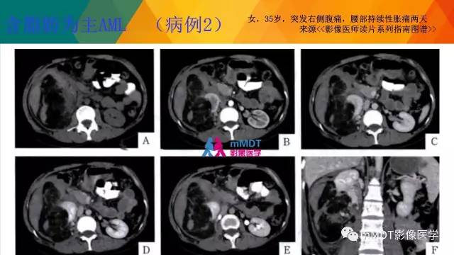 【PPT】肾血管平滑肌脂肪瘤影像表现