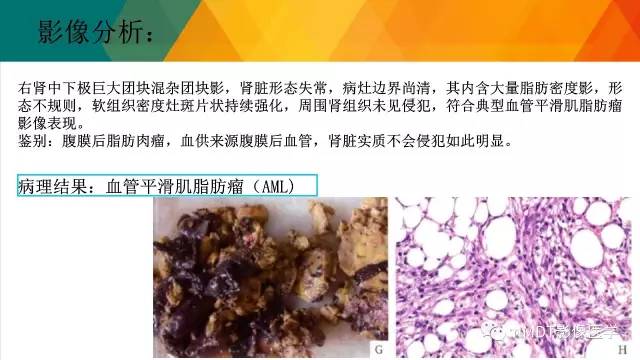 【PPT】肾血管平滑肌脂肪瘤影像表现