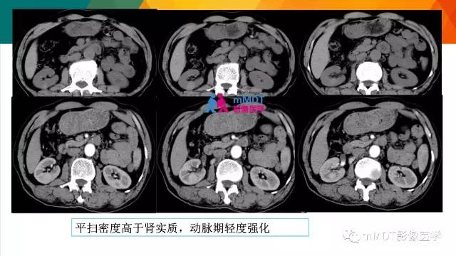 【PPT】肾血管平滑肌脂肪瘤影像表现