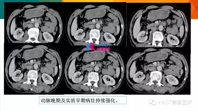 【PPT】肾血管平滑肌脂肪瘤影像表现