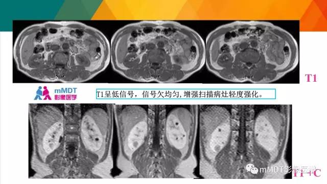 【PPT】肾血管平滑肌脂肪瘤影像表现
