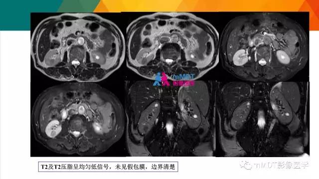 【PPT】肾血管平滑肌脂肪瘤影像表现