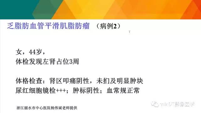 【PPT】肾血管平滑肌脂肪瘤影像表现