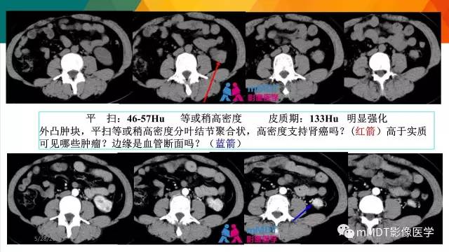【PPT】肾血管平滑肌脂肪瘤影像表现