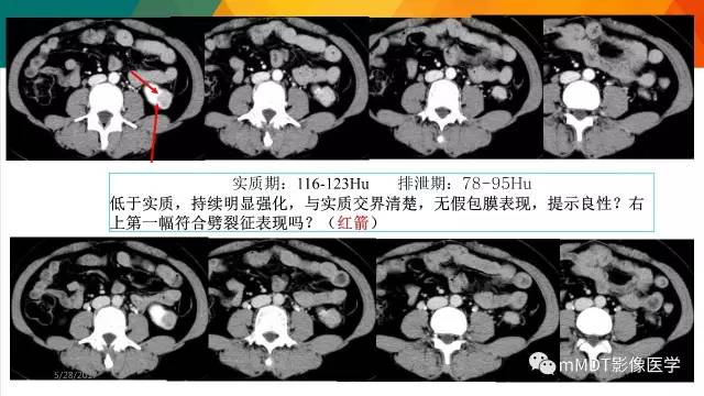 【PPT】肾血管平滑肌脂肪瘤影像表现