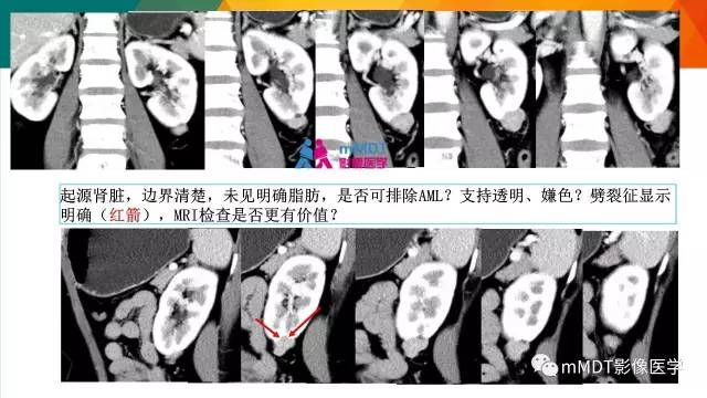 【PPT】肾血管平滑肌脂肪瘤影像表现