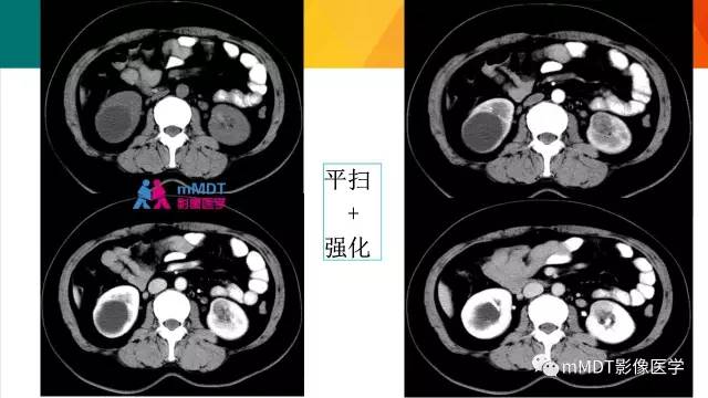 【PPT】肾血管平滑肌脂肪瘤影像表现