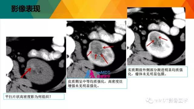 【PPT】肾血管平滑肌脂肪瘤影像表现