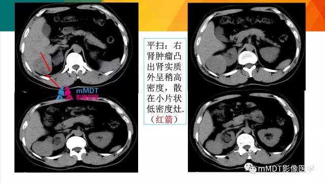 【PPT】肾血管平滑肌脂肪瘤影像表现