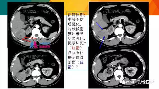 【PPT】肾血管平滑肌脂肪瘤影像表现