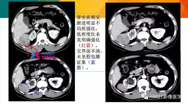 【PPT】肾血管平滑肌脂肪瘤影像表现
