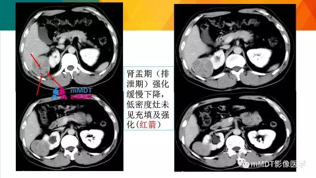 【PPT】肾血管平滑肌脂肪瘤影像表现