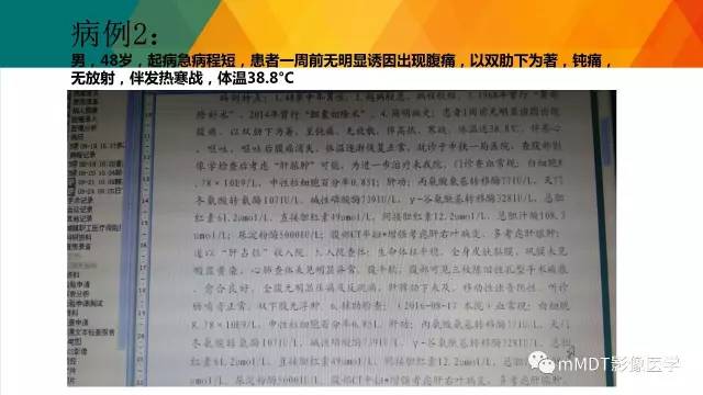 【PPT】肾血管平滑肌脂肪瘤影像表现