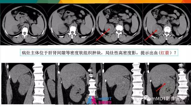 【PPT】肾血管平滑肌脂肪瘤影像表现