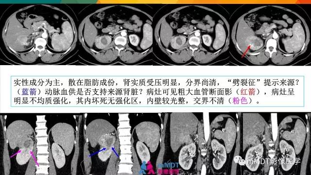 【PPT】肾血管平滑肌脂肪瘤影像表现
