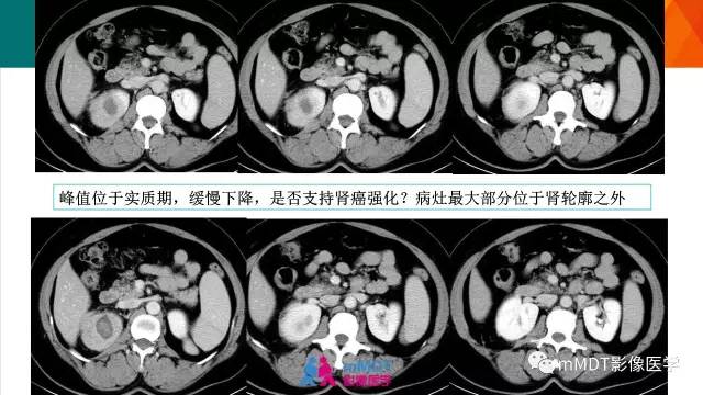 【PPT】肾血管平滑肌脂肪瘤影像表现
