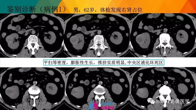 【PPT】肾血管平滑肌脂肪瘤影像表现