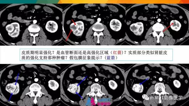 【PPT】肾血管平滑肌脂肪瘤影像表现