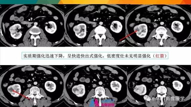 【PPT】肾血管平滑肌脂肪瘤影像表现