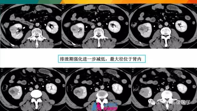 【PPT】肾血管平滑肌脂肪瘤影像表现
