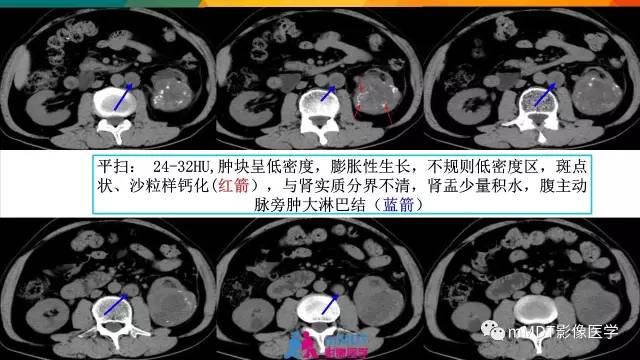 【PPT】肾血管平滑肌脂肪瘤影像表现