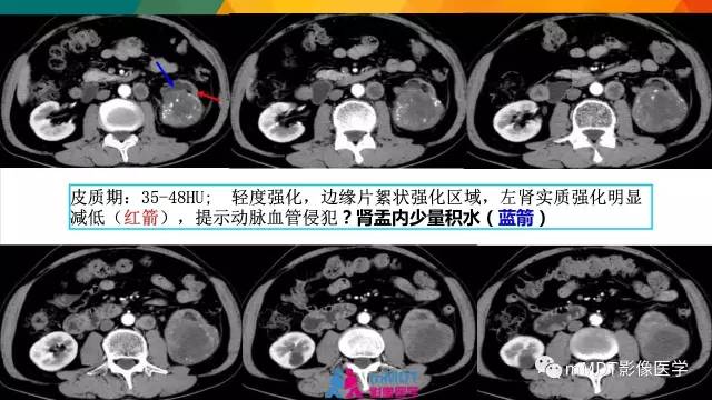 【PPT】肾血管平滑肌脂肪瘤影像表现