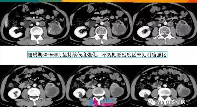 【PPT】肾血管平滑肌脂肪瘤影像表现