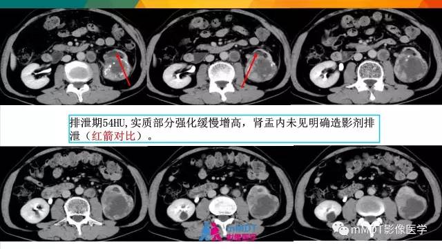 【PPT】肾血管平滑肌脂肪瘤影像表现