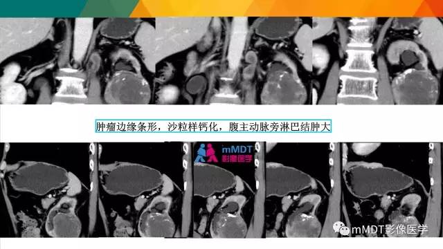 【PPT】肾血管平滑肌脂肪瘤影像表现