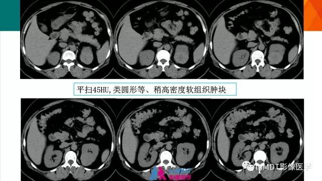 【PPT】肾血管平滑肌脂肪瘤影像表现