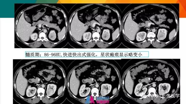 【PPT】肾血管平滑肌脂肪瘤影像表现