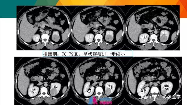 【PPT】肾血管平滑肌脂肪瘤影像表现