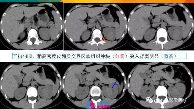 【PPT】肾血管平滑肌脂肪瘤影像表现