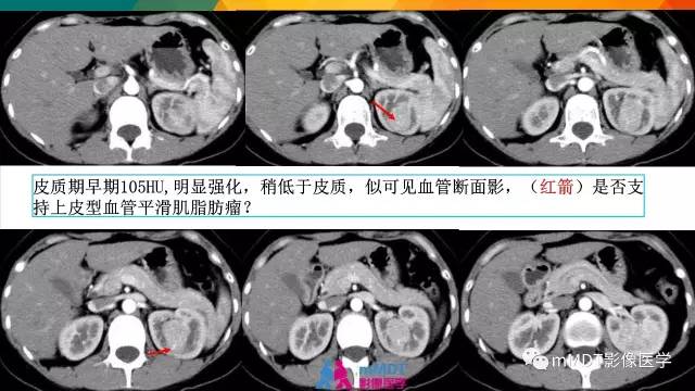 【PPT】肾血管平滑肌脂肪瘤影像表现
