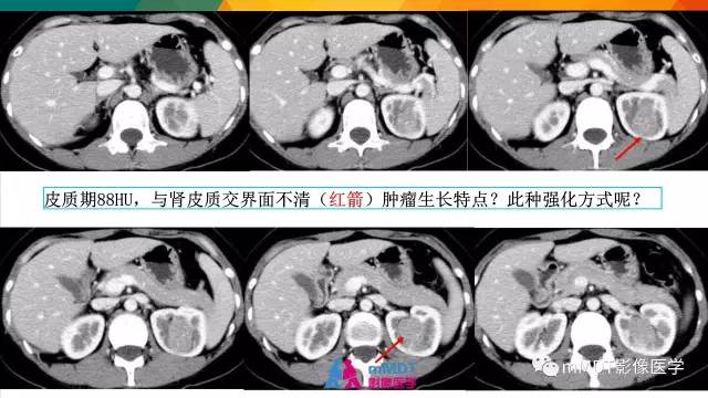 【PPT】肾血管平滑肌脂肪瘤影像表现