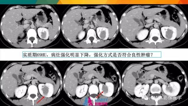 【PPT】肾血管平滑肌脂肪瘤影像表现