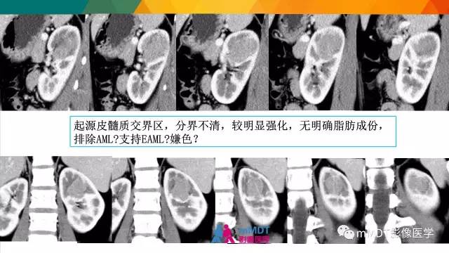【PPT】肾血管平滑肌脂肪瘤影像表现