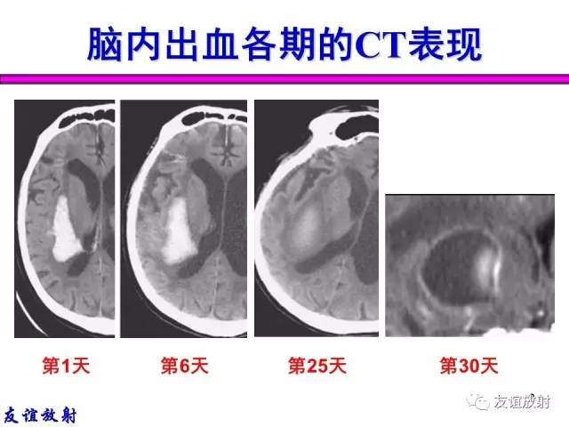 【PPT】基本病变的MR信号分析——出血MRI信号演变及分子机制