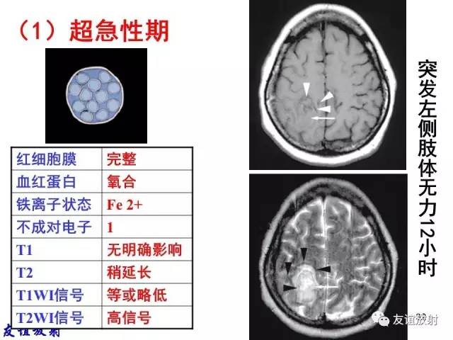 【PPT】基本病变的MR信号分析——出血MRI信号演变及分子机制