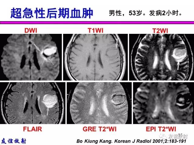 【PPT】基本病变的MR信号分析——出血MRI信号演变及分子机制
