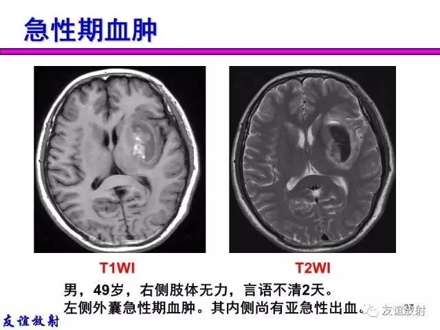 【PPT】基本病变的MR信号分析——出血MRI信号演变及分子机制