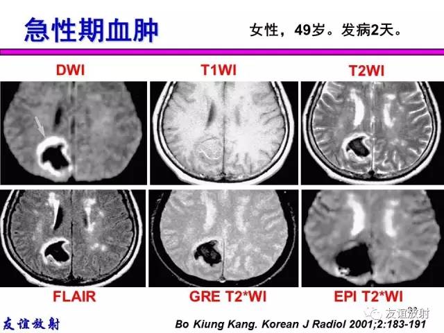 【PPT】基本病变的MR信号分析——出血MRI信号演变及分子机制