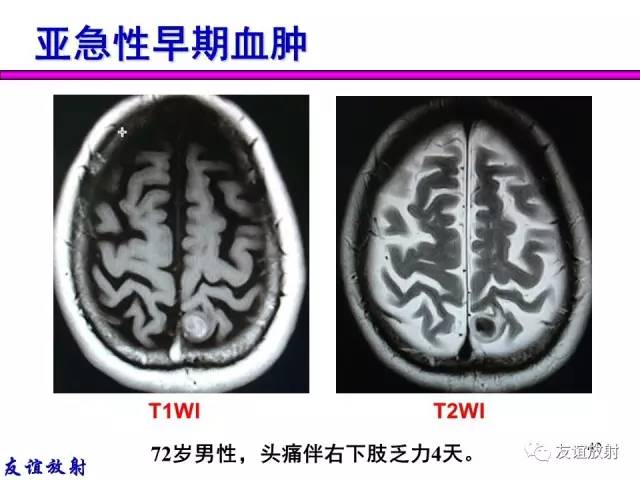 【PPT】基本病变的MR信号分析——出血MRI信号演变及分子机制