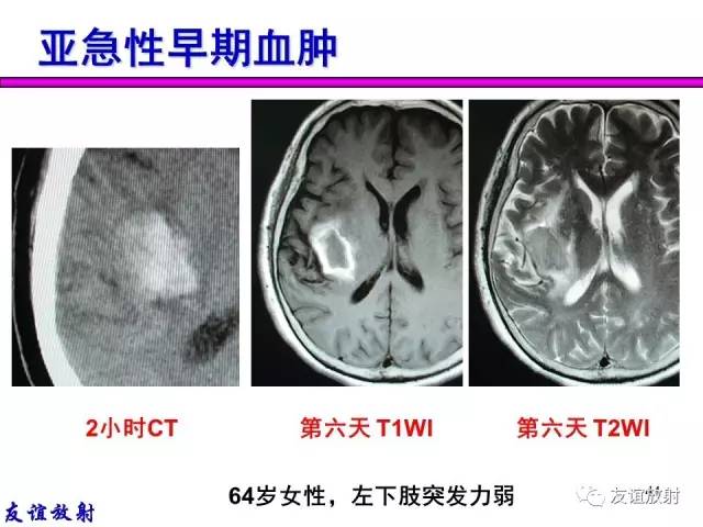 【PPT】基本病变的MR信号分析——出血MRI信号演变及分子机制