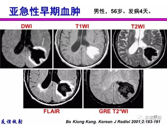 【PPT】基本病变的MR信号分析——出血MRI信号演变及分子机制