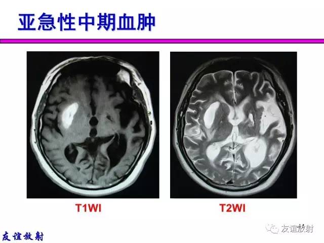 【PPT】基本病变的MR信号分析——出血MRI信号演变及分子机制
