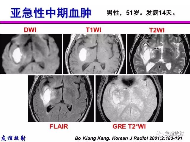 【PPT】基本病变的MR信号分析——出血MRI信号演变及分子机制