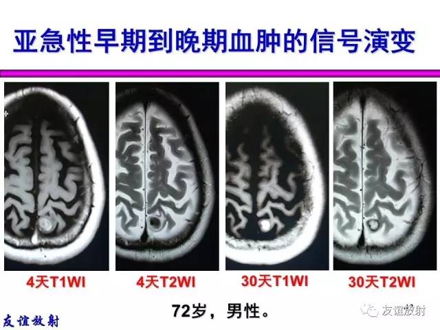 【PPT】基本病变的MR信号分析——出血MRI信号演变及分子机制