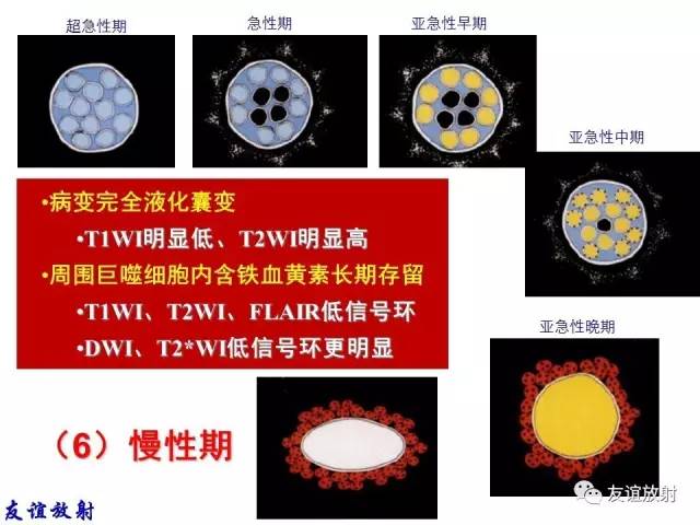【PPT】基本病变的MR信号分析——出血MRI信号演变及分子机制
