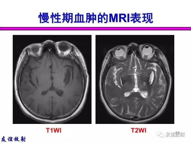 【PPT】基本病变的MR信号分析——出血MRI信号演变及分子机制